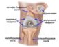 Травма колена, контузионные изменения бедренной кости