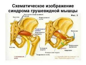 Синдром грушевидной мышцы?