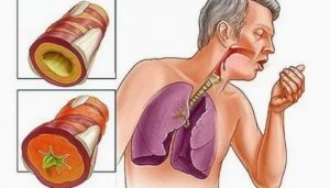 Одышка, мокрота не отходит, тяжело дышать