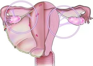 Боли при спайках и беременнсть