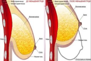 Резко уменьшилась грудь