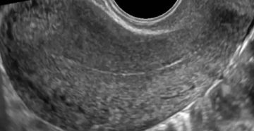 Тонкий эндометрий Тонкий эндометрий