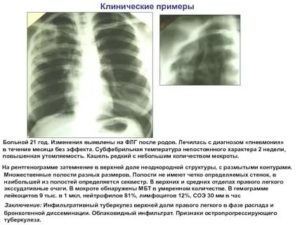 Кашель в течении 2 недель без температуры