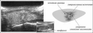 Лимфоузлы пониженной эхогенности