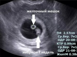 На 24 дпп нет эмбриона и желточного мешочка