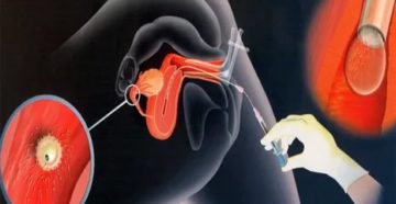 Не получается оплодотворить жену Не получается оплодотворить жену