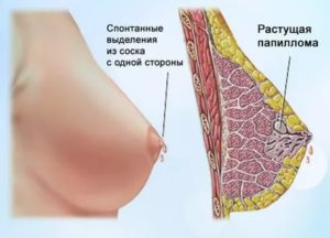 Боль в груди и выделения из соска