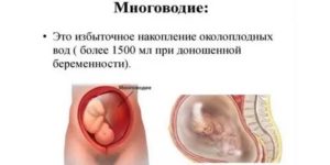 Многоводие на 29 неделе беременности