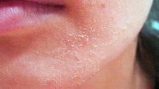 Аллергия, шелушение кожи