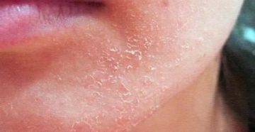 Аллергия, шелушение кожи