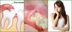 Растет зуб мудрости, опухла щека при беременности