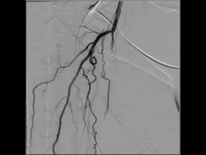 Окклюзия лучевой артерии