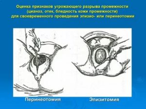 Опухла промежность