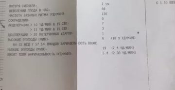 Расшифровка КТГ на 32 неделе Расшифровка КТГ на 32 неделе