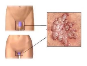 Болезненное образование на половой губе