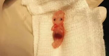 Срок беременности 7-8 недель. Начались кровянистые выделения