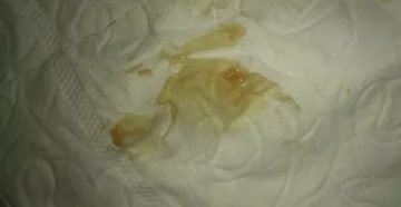 Коричневые выделения через месяц после чистки матки Коричневые выделения через месяц после чистки матки