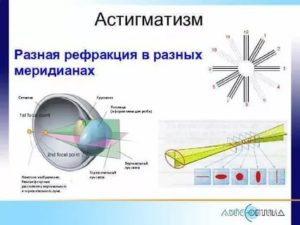 Какая разница рефракции в двух главных меридианах в дптр (астигматизм)