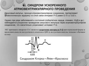 Ускоренная AV проводимость у беременных