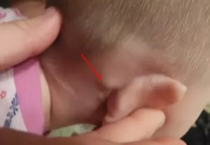 Шишечка за ухом у грудничка