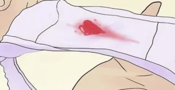 Посткоитальное кровотечение Посткоитальное кровотечение