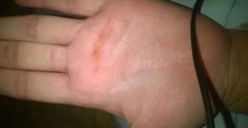 Темно коричневые точки на ладонях и пальцах