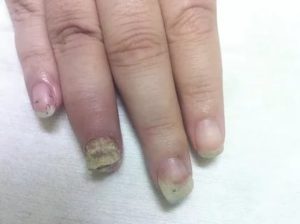 Грибок ногтя, почесуха всего тела в разных местах