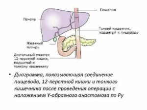 Операция 12 перстной кишки удалили часть кишечника