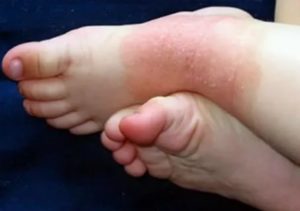Покраснение и шелушение кожи на ногах