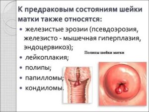 Болезни шейки матки