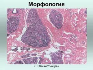 Лечение слизистого рака молочной железы