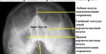 Тень на рентгене придаточных пазух носа