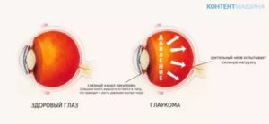 Глаукома 4 стадии, операция по улучшению зрения