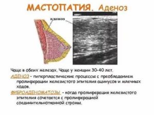 Преобладание железистой ткани