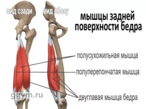 Отрыв сухожилия длинной головки двуглавой мышцы бедра от седалищного бугра