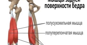 Отрыв сухожилия длинной головки двуглавой мышцы бедра от седалищного бугра