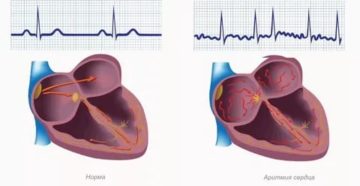 Нарушение сердечного ритма