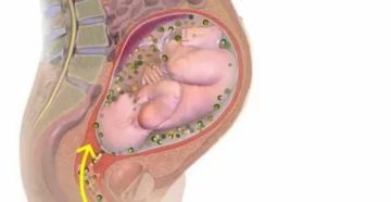 Диагноз плацентит