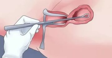 Повторное выскабливание Повторное выскабливание