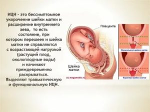 Укорочение шейки матки ицн