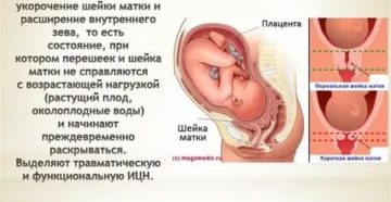 Укорочение шейки матки ицн Укорочение шейки матки ицн