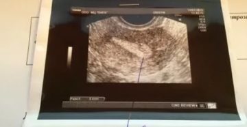 Узи на 21 день цикла Узи на 21 день цикла