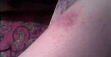 На ноге покраснение, зуд, волдыри