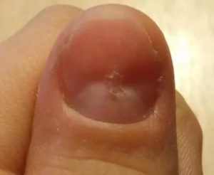 Повреждение матрикса ногтя