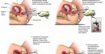 Можно ли зделать аборт на сроке 12 недель