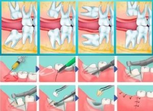 Удаление зуба мудрости, отек, жидкость из раны