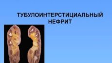 Тубулоинтерстициальный нефрит?