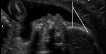 Узи плода 36 недель. Диагноз микроцефалия Узи плода 36 недель. Диагноз микроцефалия