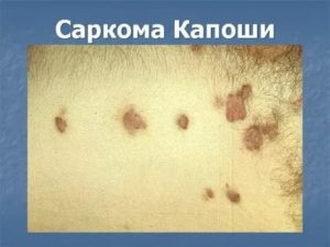 Саркома капоши