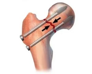 Остеосинтез шейки бедра